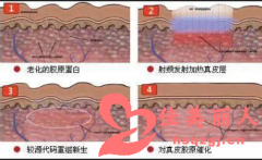 目前去除法令纹较好的方式是什么？