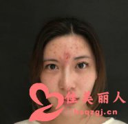 线雕隆鼻痛不痛 术后多久能不痛