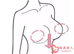 如何挽救乳房下垂？乳房下垂矫正的方法是什么