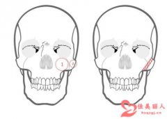 颧骨内推是什么原理 是怎么做的
