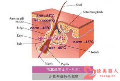 冰肌脱毛和冰点脱毛的区别是什么