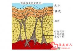 光波拉皮除皱的危害和副作用是什么