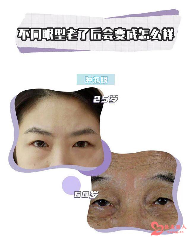 重庆星宸整形医院暑期双眼皮钜惠活动 省到不行