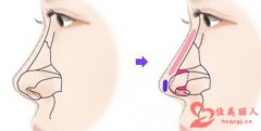 朝天鼻怎么矫正 进行矫正需要多少钱