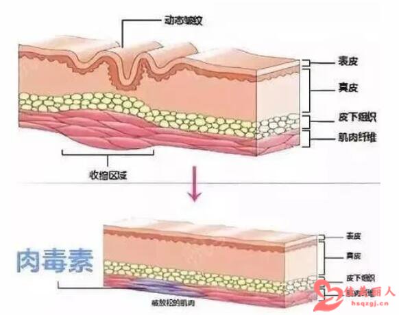 上海九院祝联医生：RD素去皱的适应症