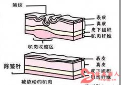 打了眉间除皱针什么时候开始有效果