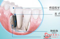 种植牙价格是多少 一般使用寿命是多久
