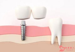成都做种植牙多少钱一颗？成都种植牙2022年价格表