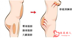 哪种丰胸手术安全效果好