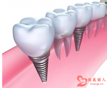 种植一颗牙齿能管多久