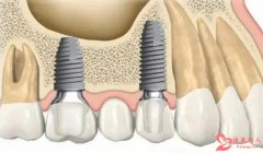 口腔医院种植牙多少钱一颗